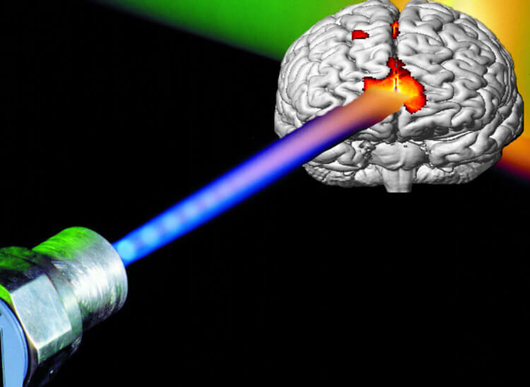 Новая идея врачей использовать лазер для лечения болезни Альцгеймера