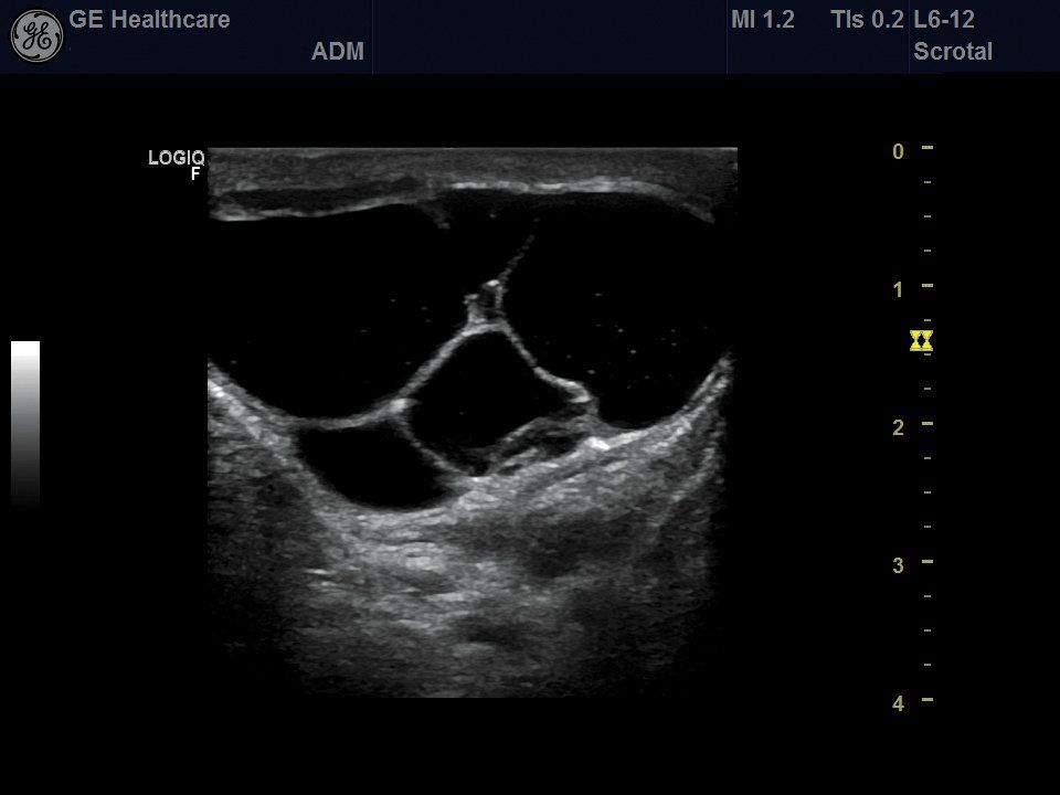 Сперматоцеле лечение. Logiq f8. Сперматоцеле яичка УЗИ. Ge Logiq f8 фото.