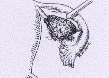 Примеры использования противоспаечного материала на примере резекции яичника