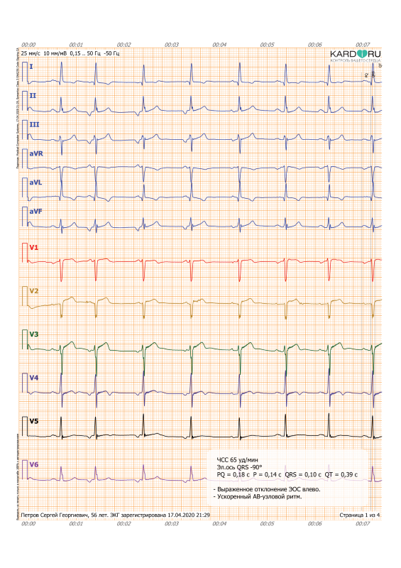 ЭКГ 6 отведений с описанием ЭКГ