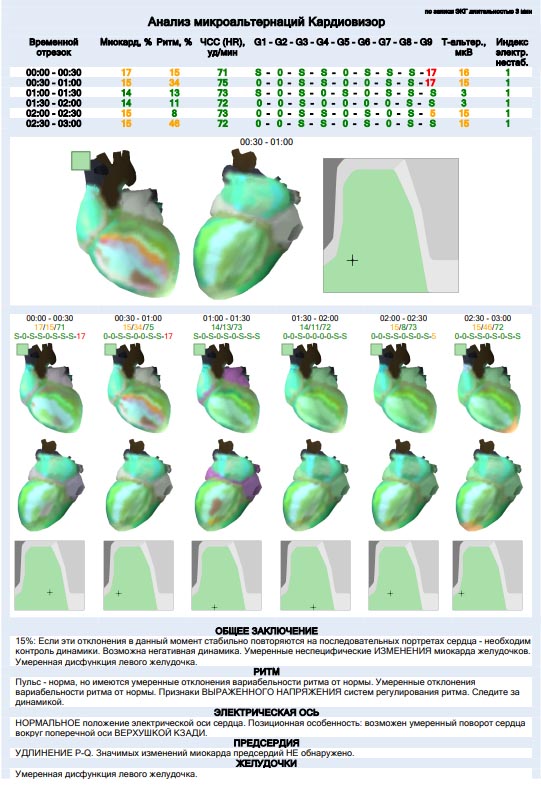 Дополнительные методы оценки ЭКГ и автоматическое заключение - изображение 2