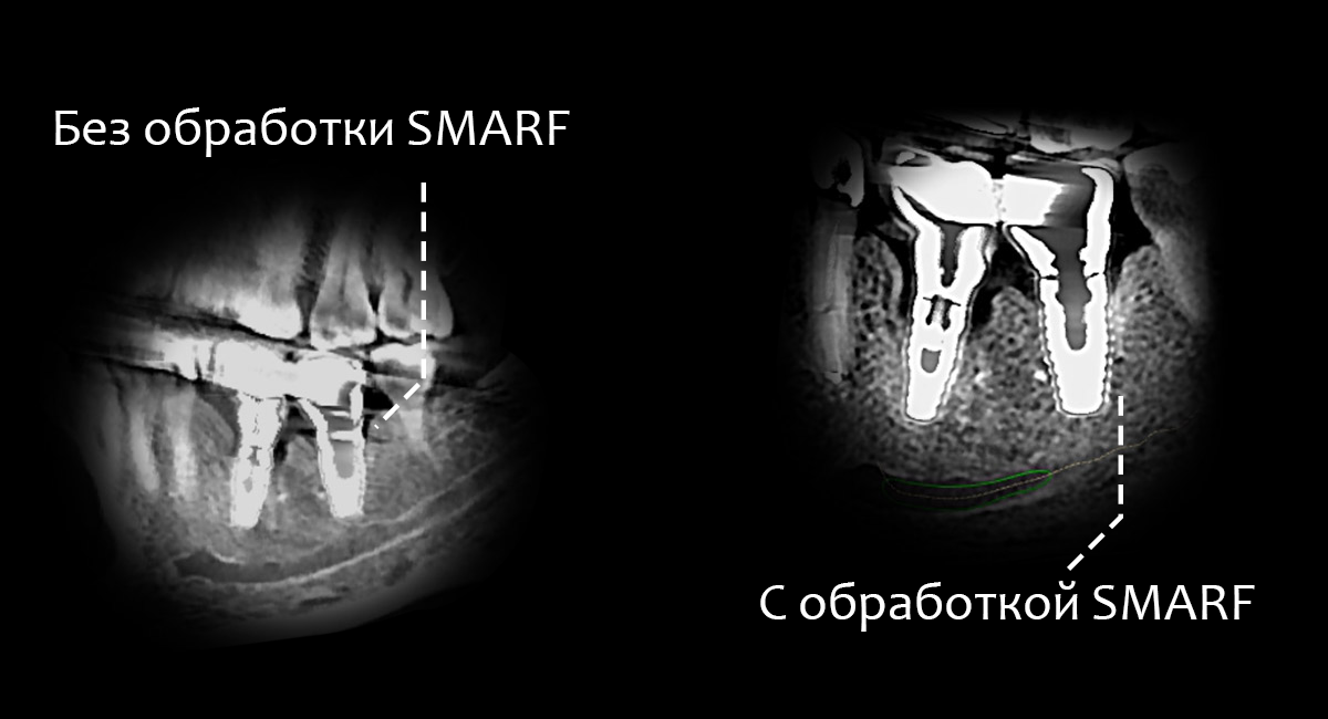 Технология SMARF