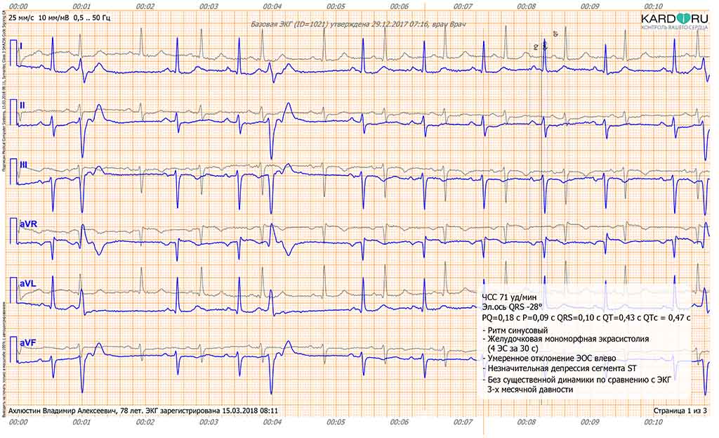 ЭКГ 6 отведений с описанием ЭКГ