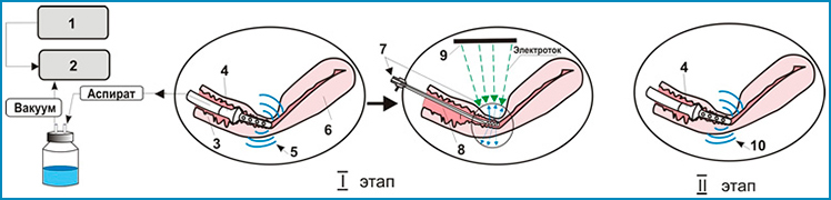 Алгоритм применения виброаспирации и вибромассажа