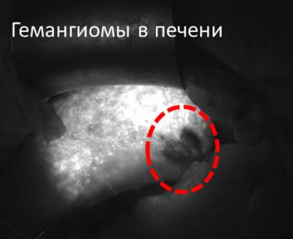 Детекция образований в печени с помощью ICG-методики