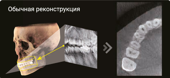 Обычная реконструкция