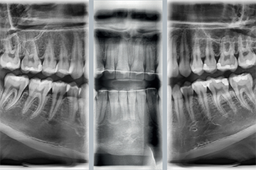 Интерпроксимальный (Bitewing) левая / фронтальная / правая проекции