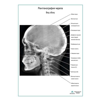 Рентгенография черепа. Вид сбоку плакат глянцевый А1+/А2+ Рентгенография черепа. Вид сбоку плакат глянцевый А1+/А2+