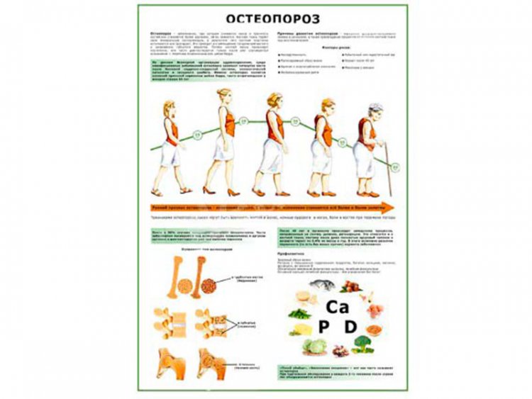 Остеопороз плакат глянцевый А1/А2