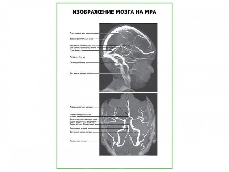 Изображение мозга на МРА плакат глянцевый А1/А2
