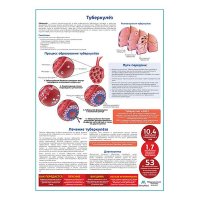 Туберкулёз медицинский плакат А1+/A2+