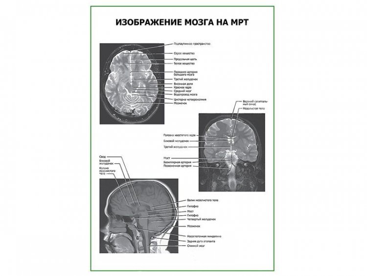 Изображение мозга на МРТ плакат глянцевый А1/А2