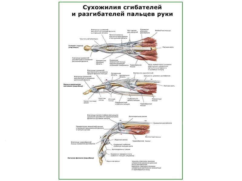 Тендинит сухожилия пальца