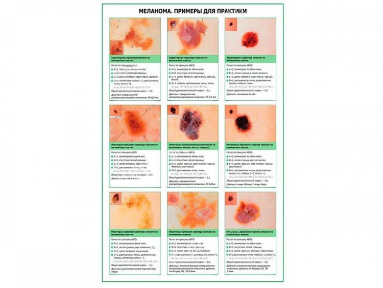 Меланома, примеры для практики, плакат глянцевый А1/А2