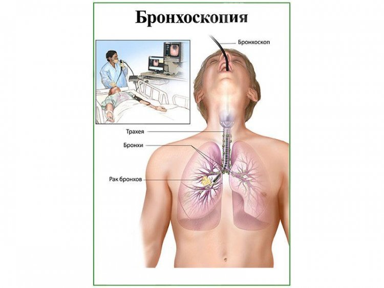 Бронхоскопия, плакат глянцевый А1/А2