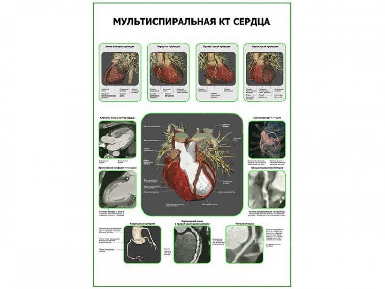 Мультиспиральная КТ Сердца плакат глянцевый  А1/А2