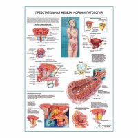 Предстательная железа. Норма и патология, плакат глянцевый А1+/А2+