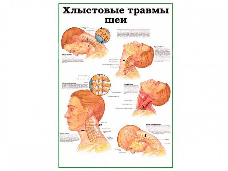 Хлыстовые травмы шеи, плакат глянцевый  А1/А2