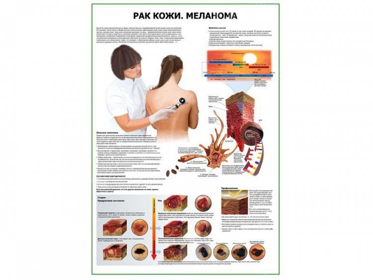Рак кожи меланома плакат глянцевый  А1/А2