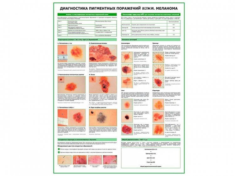 Меланома, диагностика, плакат глянцевый А1/А2