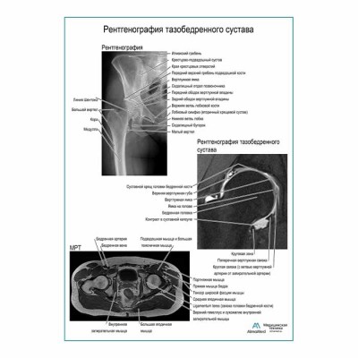 Рентгенография тазобедренного сустава плакат глянцевый А1+/А2+