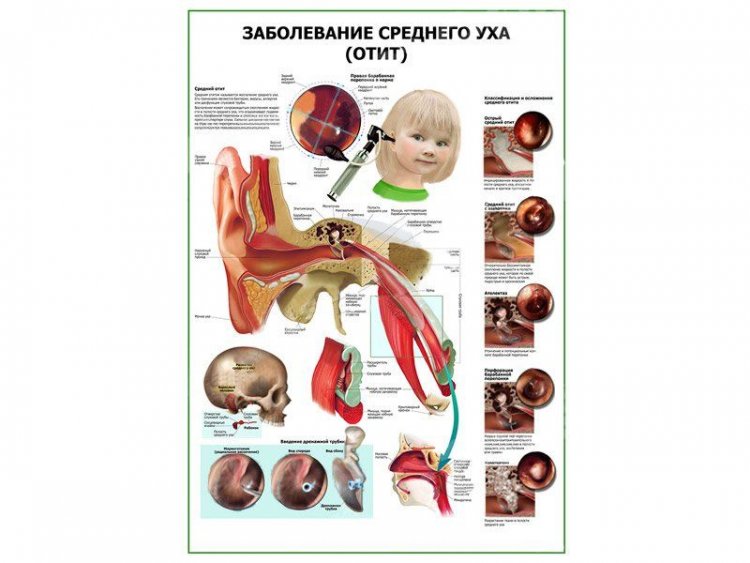 Заболевания среднего уха (отит) плакат глянцевый А1/А2