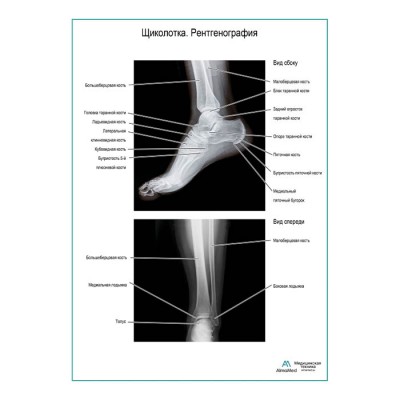 Щиколотка. Рентгенография плакат глянцевый А1+/А2+