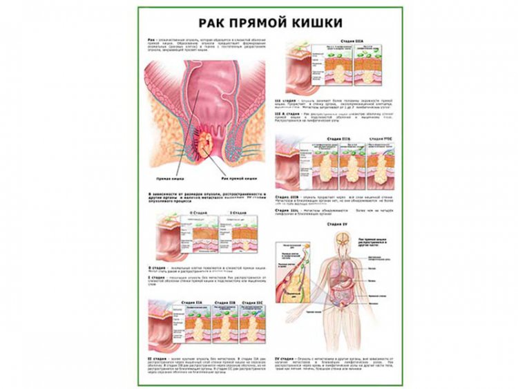 Как выглядит рак прямой кишки у мужчин