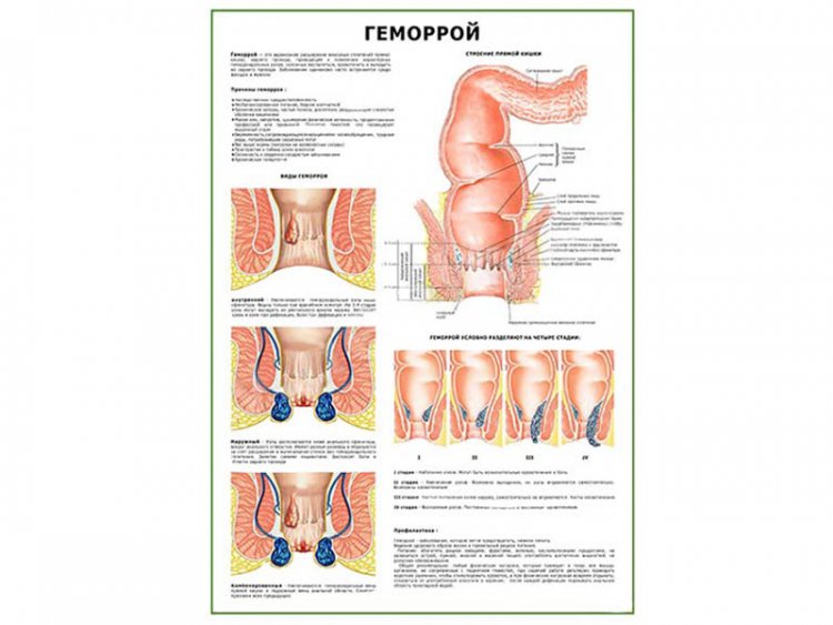 Геморрой плакат глянцевый А1/А2