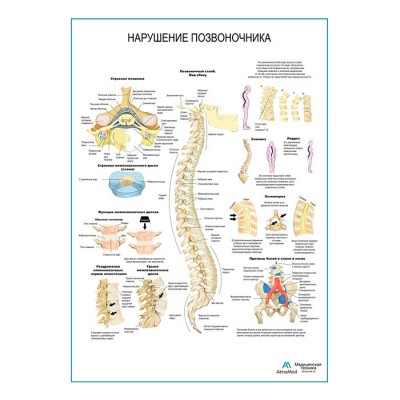 Нарушения позвоночника плакат глянцевый А1+/А2+